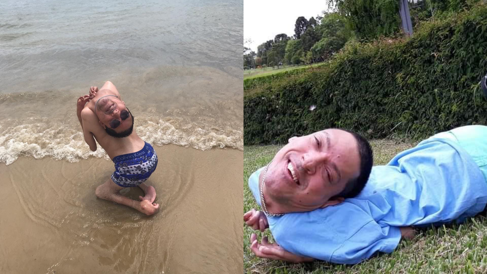 奧利維拉罹患「多發性關節炎 」，天生四肢萎縮、頭部朝下。（翻攝自Claudio Vieira de Oliveira臉書）