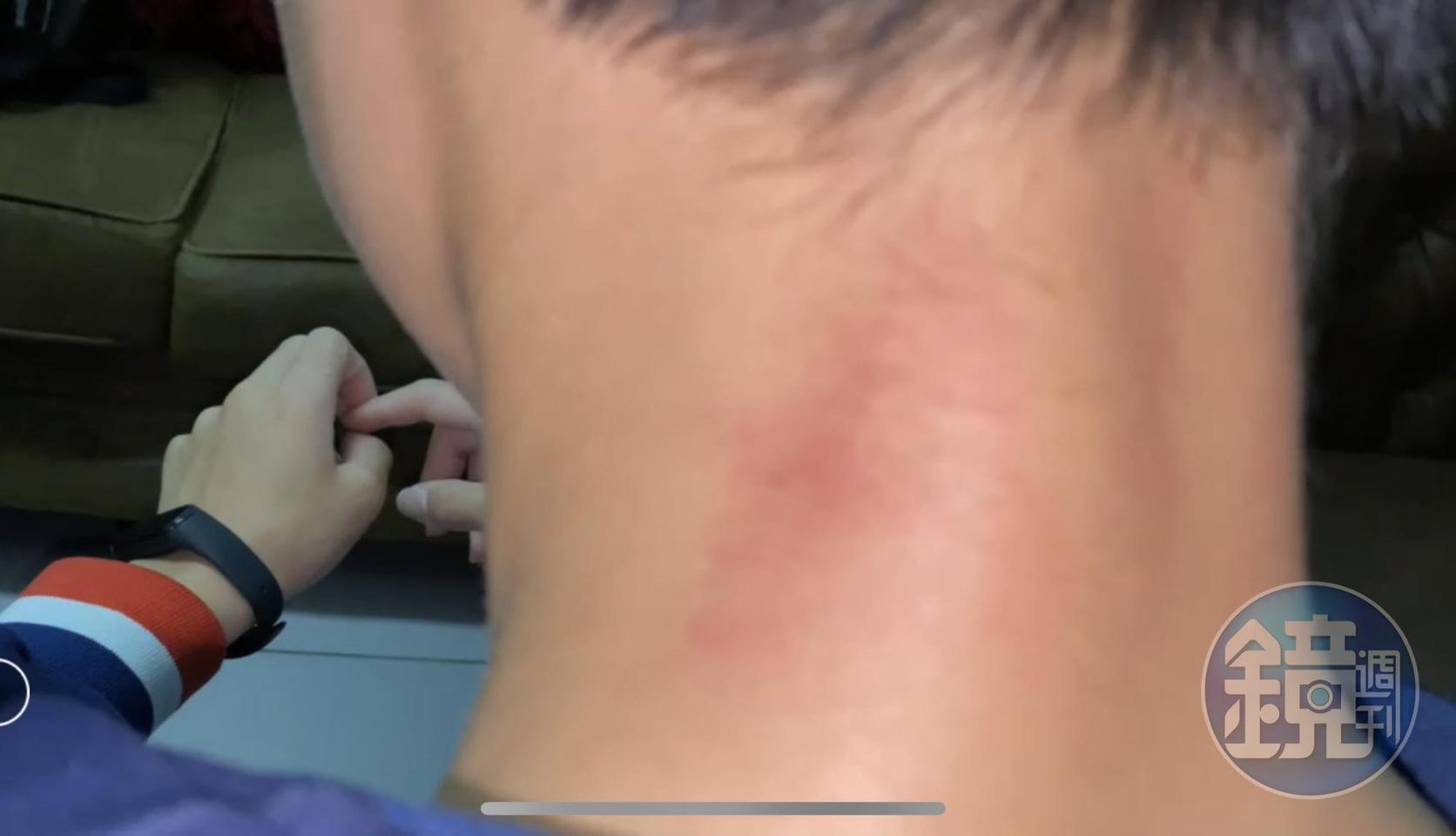 學生出面指控遭生教組長無端施暴,頭頸部出現多處挫傷。(讀者提供)