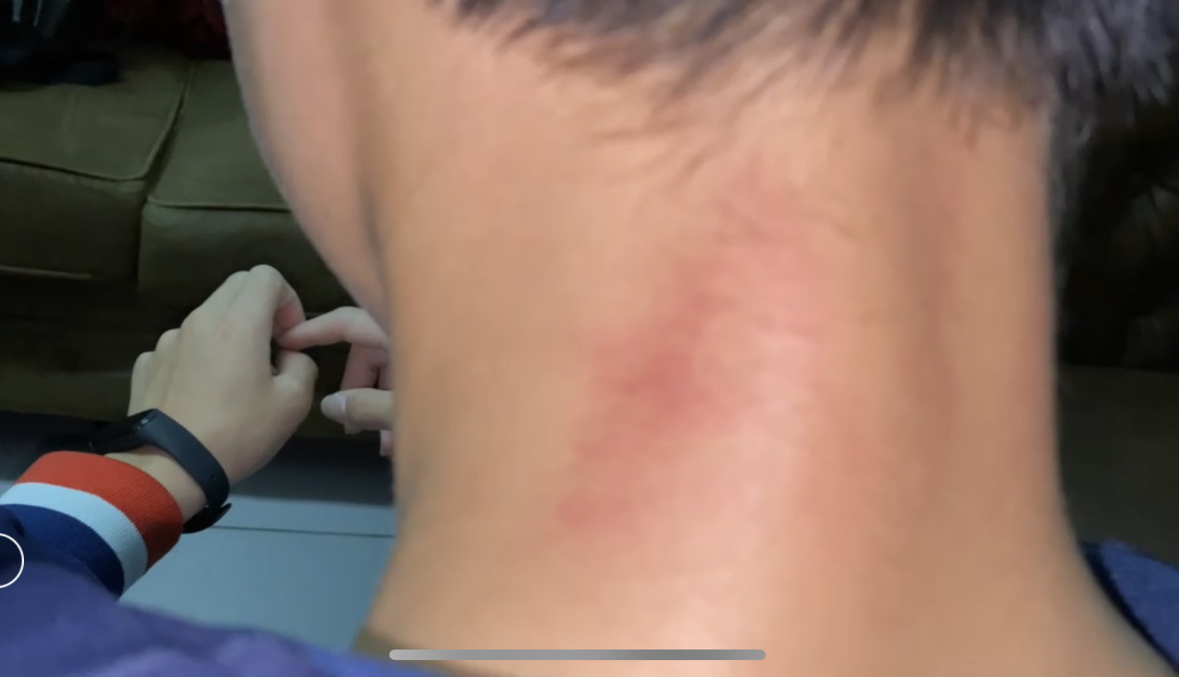 學生出面指控遭生教組長無端施暴,頭頸部出現多處挫傷。(讀者提供)