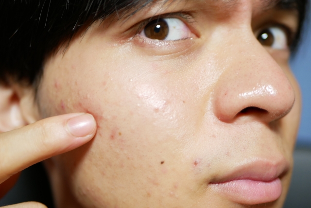 一名男子擠完痘痘後竟產生上肢癱瘓的後遺症。（示意圖，photo-AC）