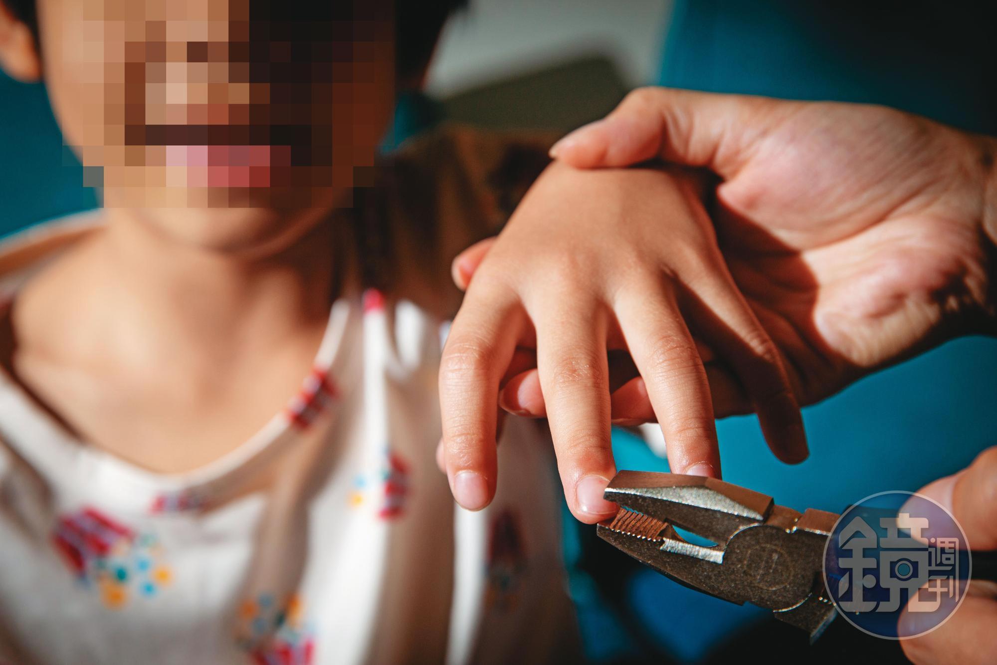 5歲男童遭外婆不定期拔除指甲,手指滿是血跡及結痂。(示意圖,非當事人)