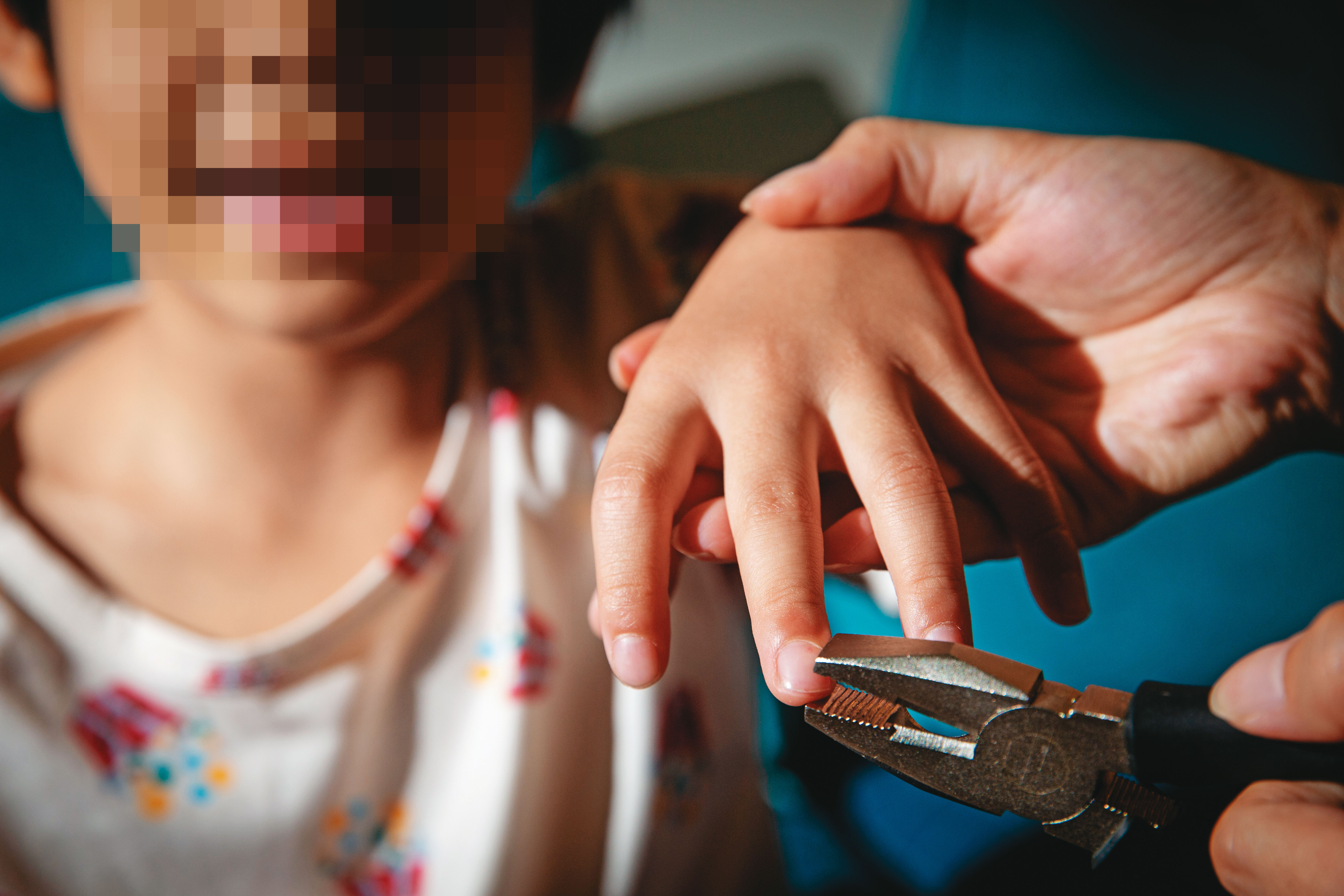 5歲男童遭外婆不定期拔除指甲,手指滿是血跡及結痂。(示意圖,非當事人)