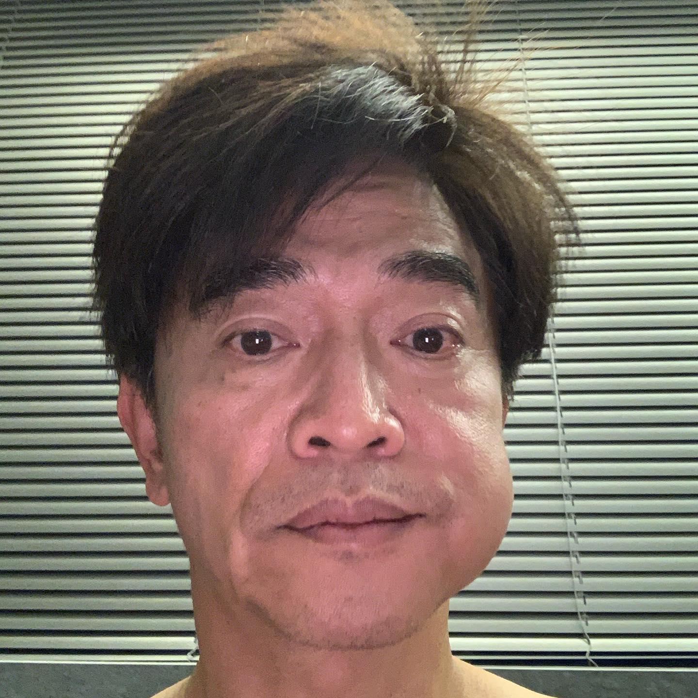 吳宗憲去整理牙齒，臉腫了一大包。（翻攝自吳宗憲臉書）