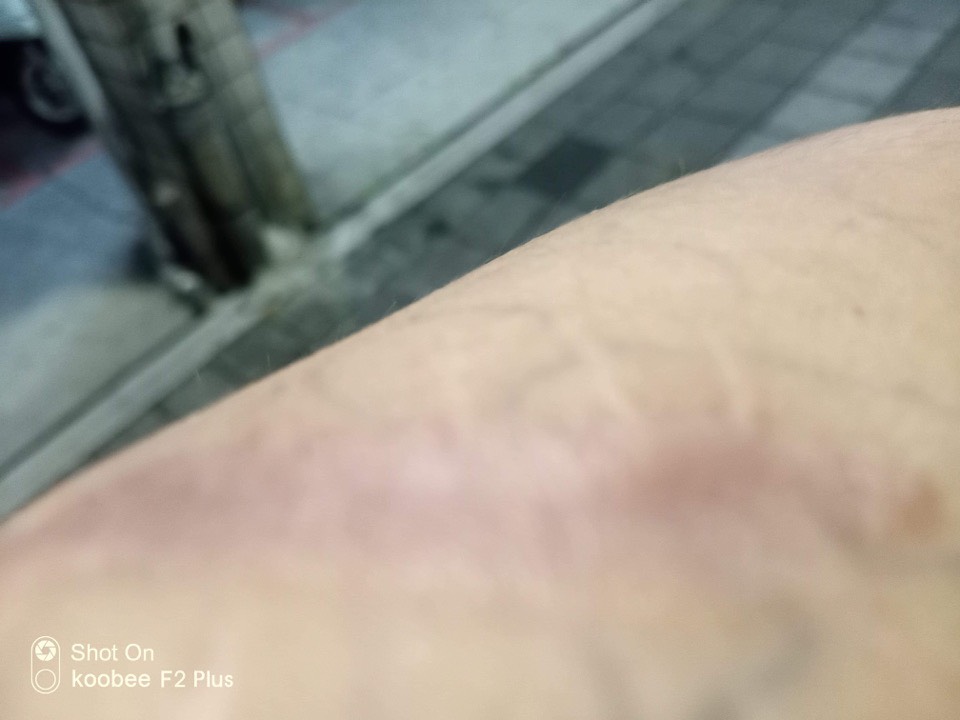 男子控訴父親曾教唆哥哥持刀砍他,左手臂留下長達5公分的傷疤。(讀者提供)