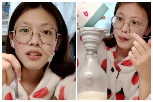 20歲王雨知罹患罕見疾病「克隆氏症」，腸胃無法消化食物，僅能依靠鼻胃管攝取營養。（翻攝自微博） 