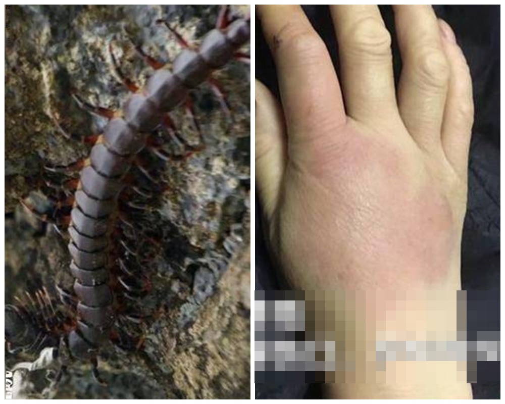 中國江蘇常州市一名女子，穿衣服時不慎被蜈蚣咬傷，經全力搶救後，仍因窒息死亡。（翻攝自搜狐新聞）