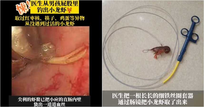 中國大陸少年效仿荒野求生節目橋段，將小龍蝦塞進肛門內。（翻攝自微博）