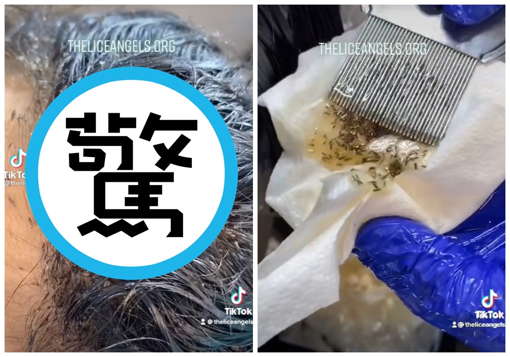 美國一名女孩頭髮長滿了頭蝨，梳過頭的梳子上出現一攤蟲屍和黃色汁液混雜的液體。（翻攝自TikTok@theliceangels）