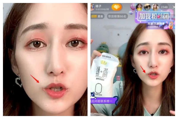 大陸知名吃播網紅「吃不飽的晴子」近日被發現嘴角明顯潰爛且牙齒發黑。 （翻攝自微博）