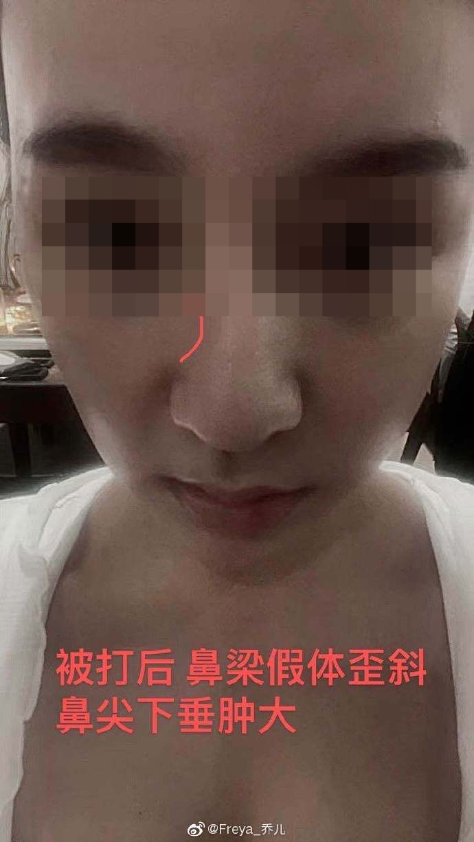 女子表示自己動過刀的鼻樑被打歪,鼻尖下垂腫大。(翻攝自微博)