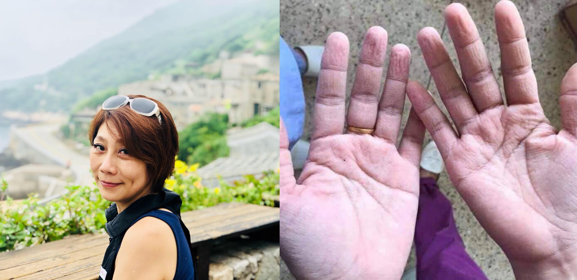 郎祖筠貼出醫護人員脫下手套後皺巴巴的雙手，讓許多網友不捨。（翻攝自郎祖筠臉書）