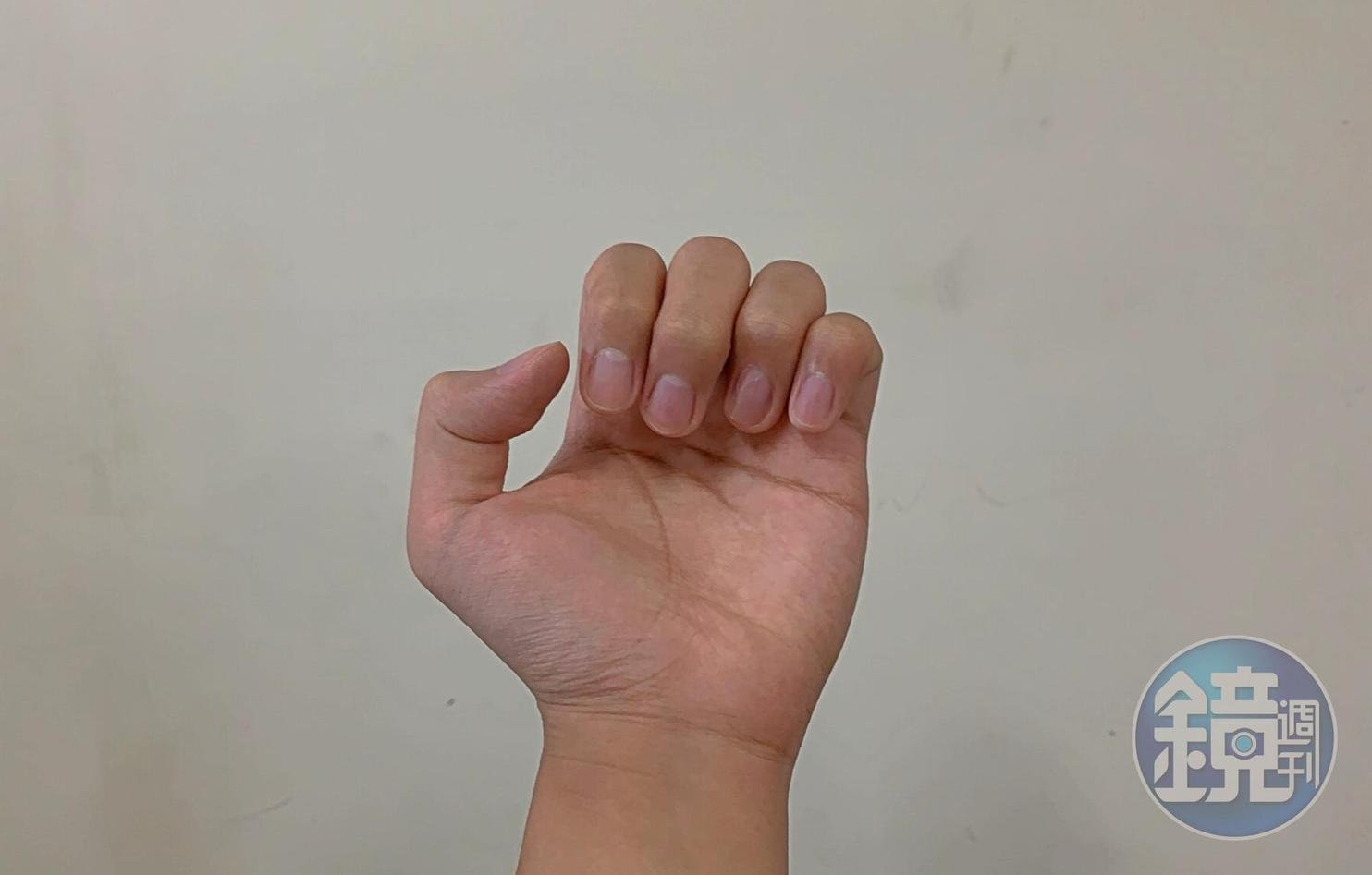 醫師郭彥良分享觀察指甲，就能簡單判定血氧濃度的方法。（示意圖）