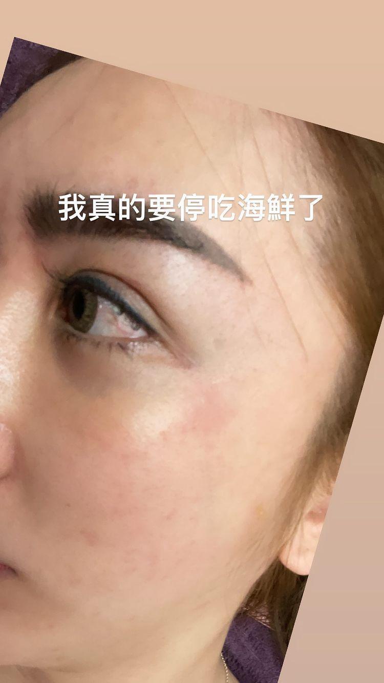 由於罔腰最近愛吃蝦子,疑似因此造成過敏,讓她覺得該忌口一下了。(翻攝自罔腰IG)