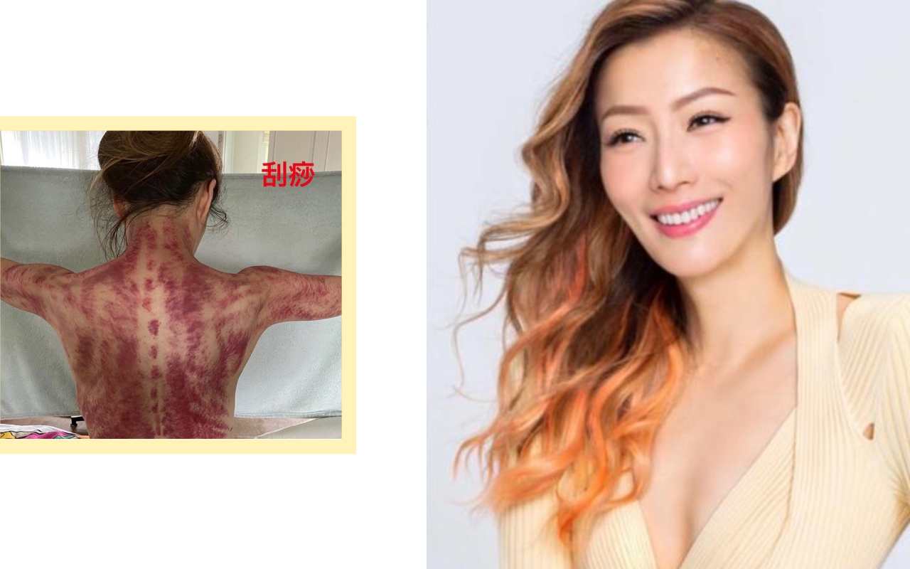 鄭秀文秀出剛刮完痧的照片，笑說自己看起來有些「驚嚇趕客」。（翻攝自鄭秀文IG）