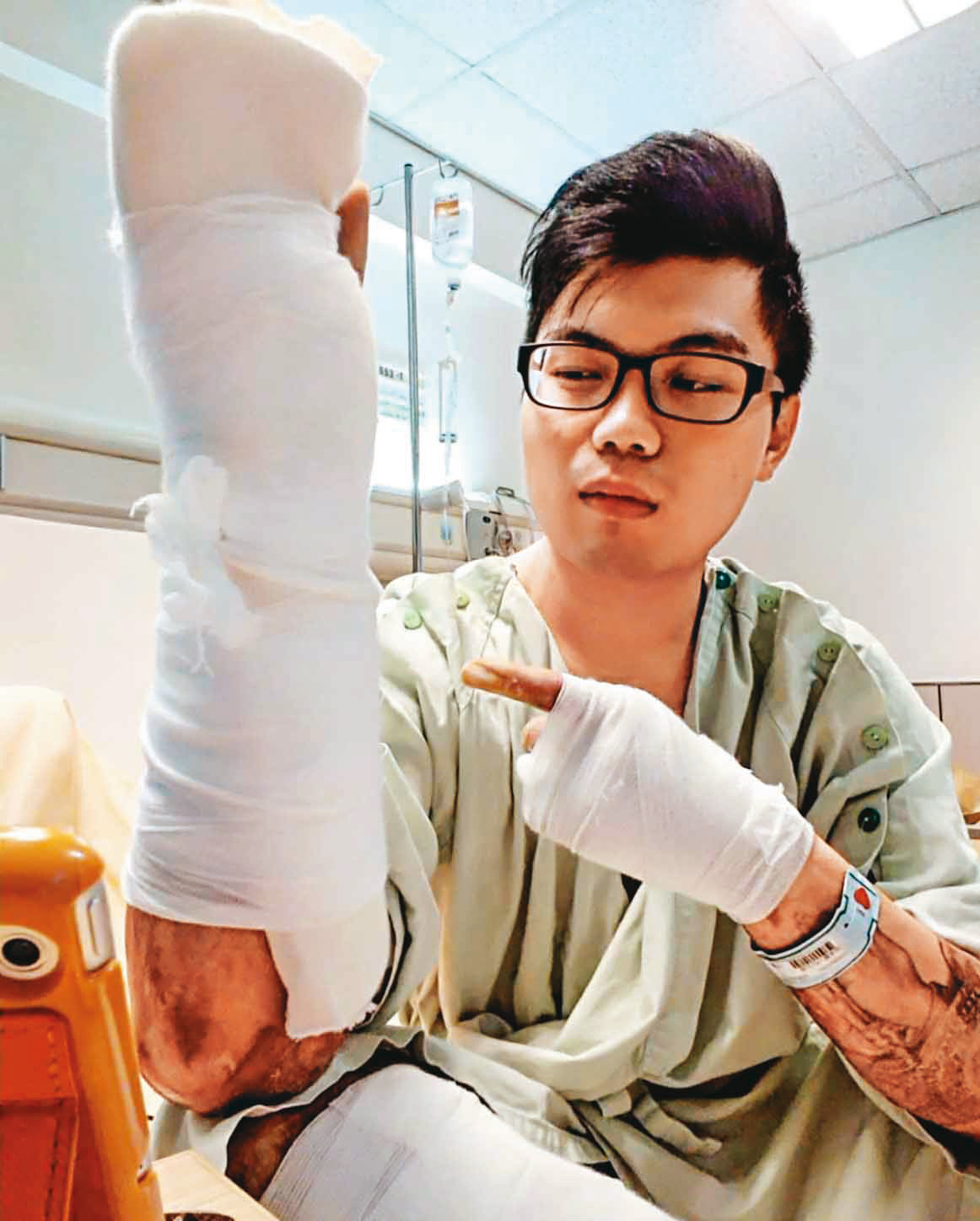 塵爆導致張承騏全身55％燒傷，其中47％為2到3度灼傷。（張承騏提供）