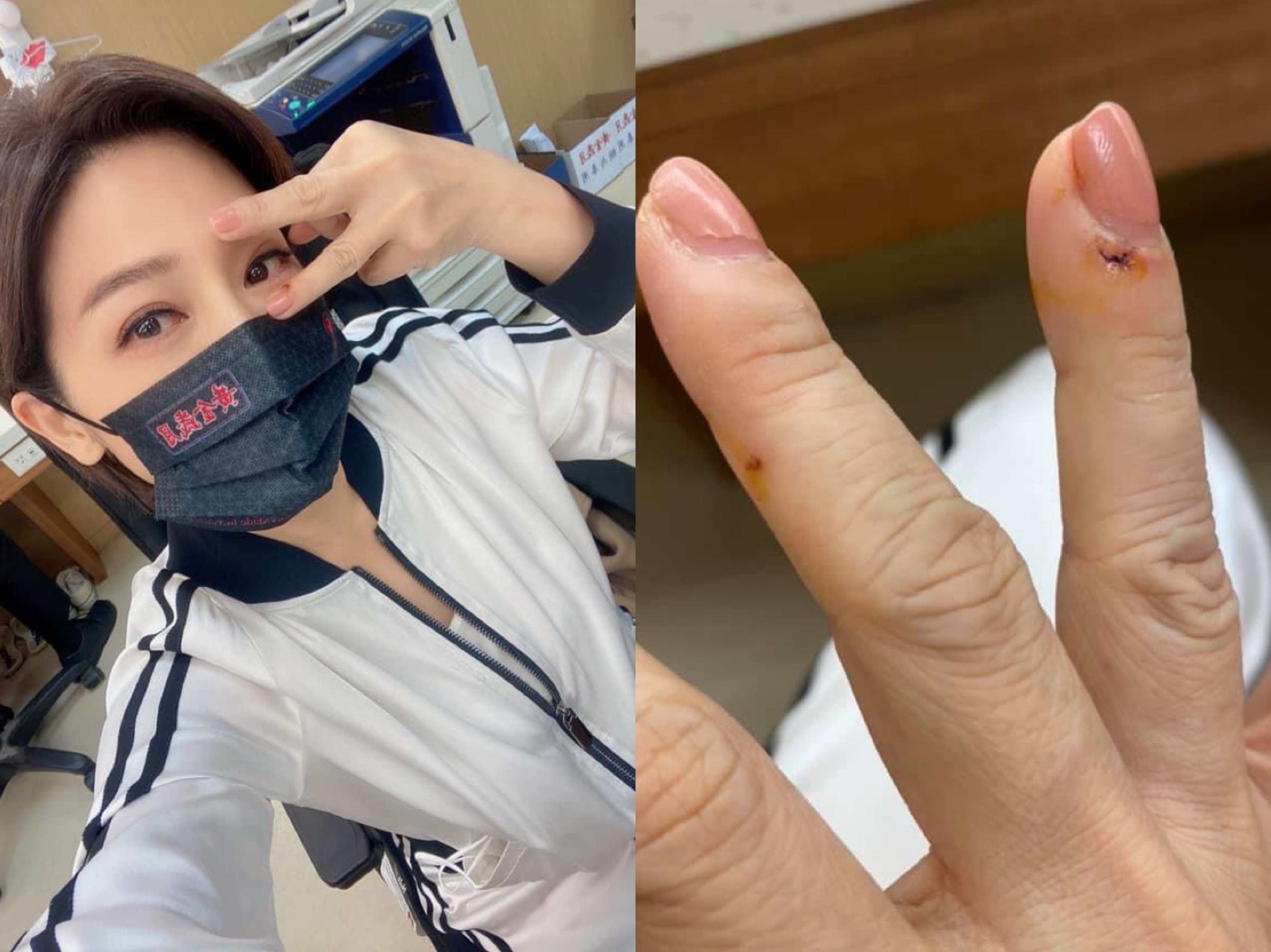 王彩樺自曝遭愛犬咬傷見血。（翻攝自王彩樺臉書）