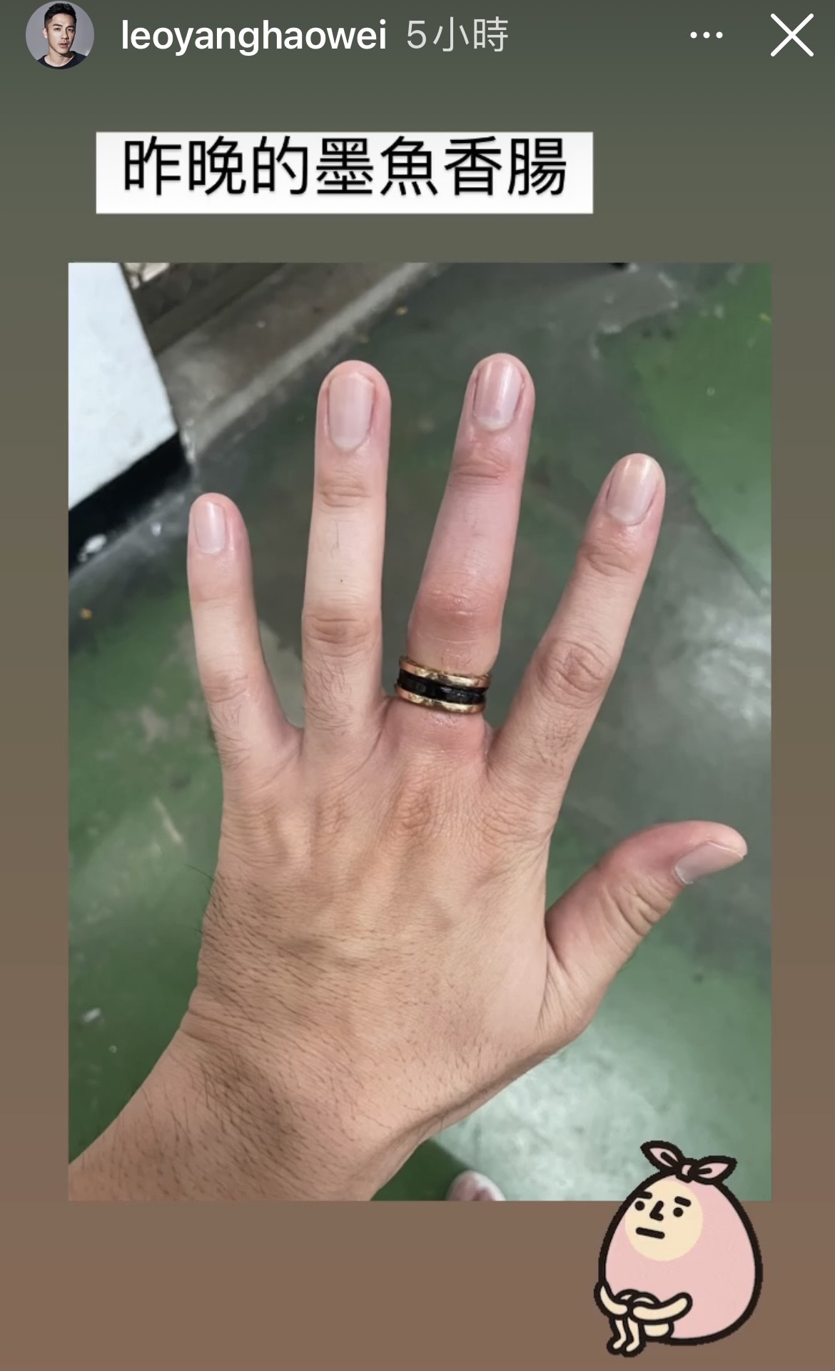 楊皓崴中指因戒指卡住血液循環不良發黑，宛如墨魚香腸。（翻攝自楊皓崴IG）