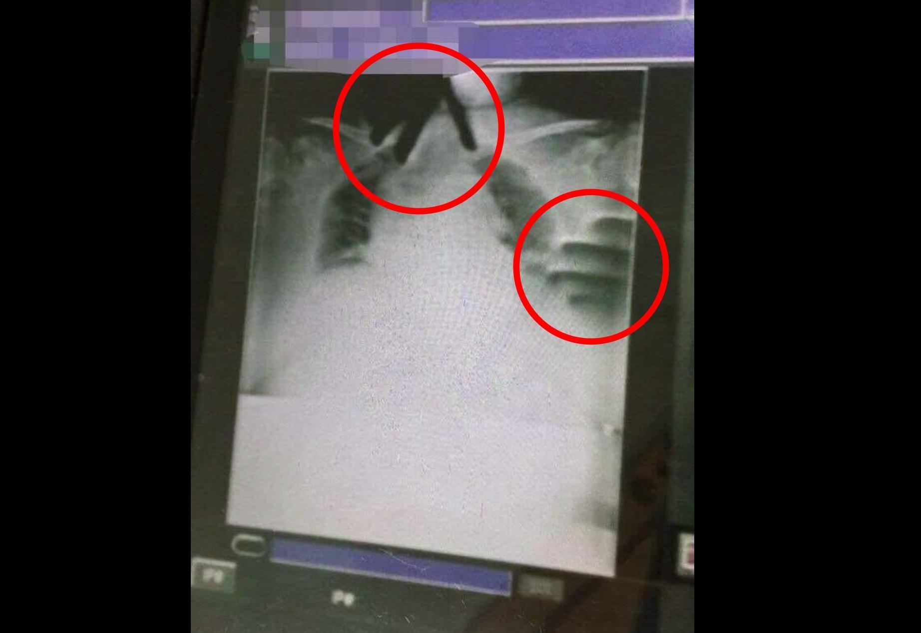一名阿嬤住院期間突然不舒服,照X光竟驚見有2隻手正掐著她。(翻攝自「靈異公社」臉書)