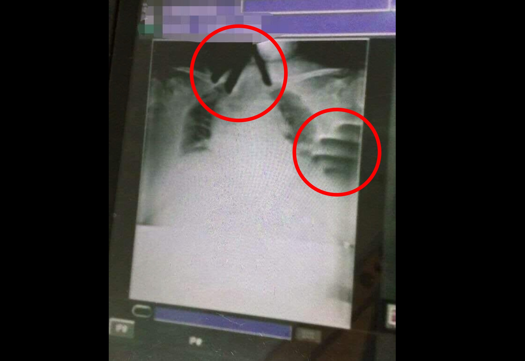 一名阿嬤住院期間突然不舒服，照X光竟驚見有2隻手正掐著她。（翻攝自「靈異公社」臉書）