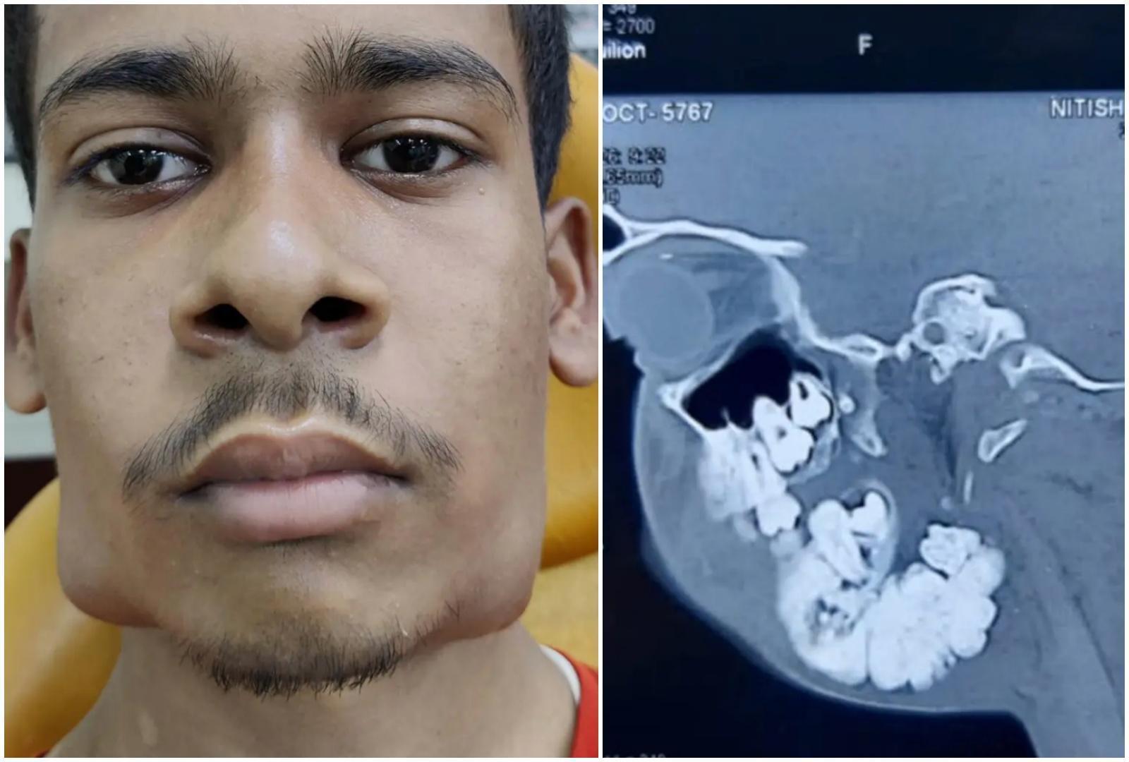 印度一名17歲的少年竟擁有82顆牙齒，最後經過手術將其摘除。（翻攝自Smart Newsline推特）