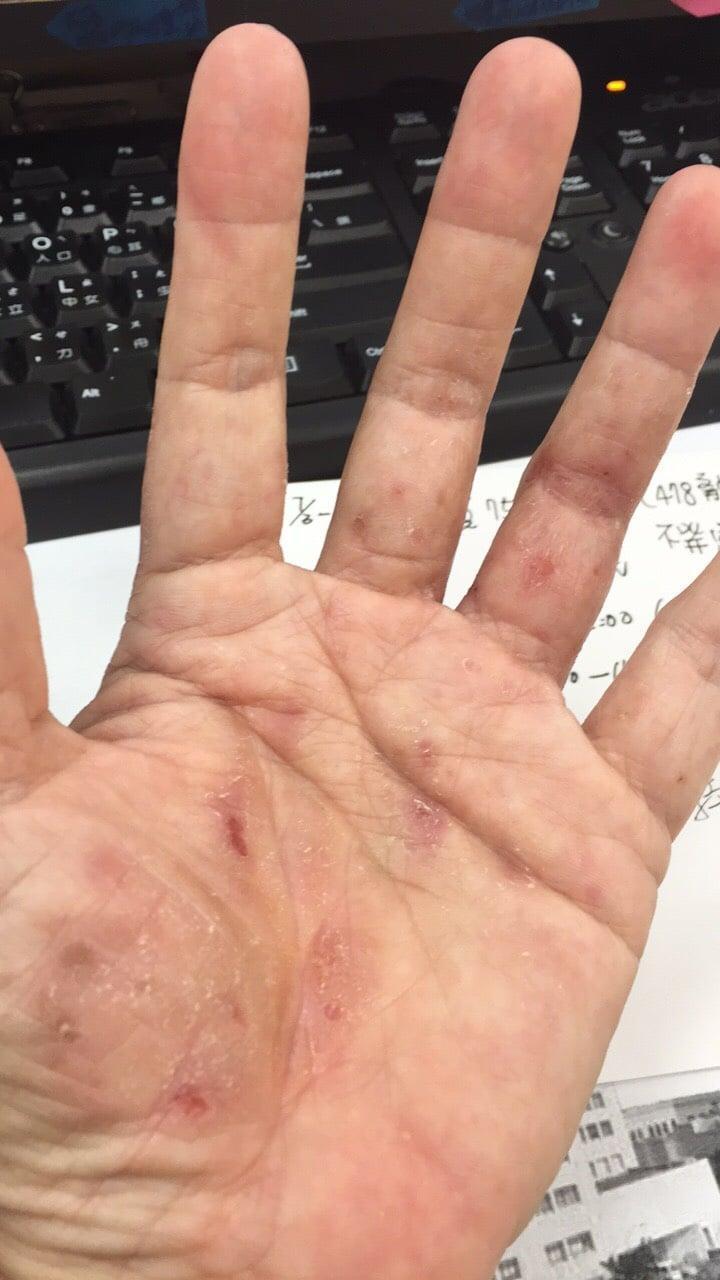 朱家祥貼出醫護人員完成大型疫苗接種站後,滿手傷痕累累。(翻攝自朱家祥臉書)
