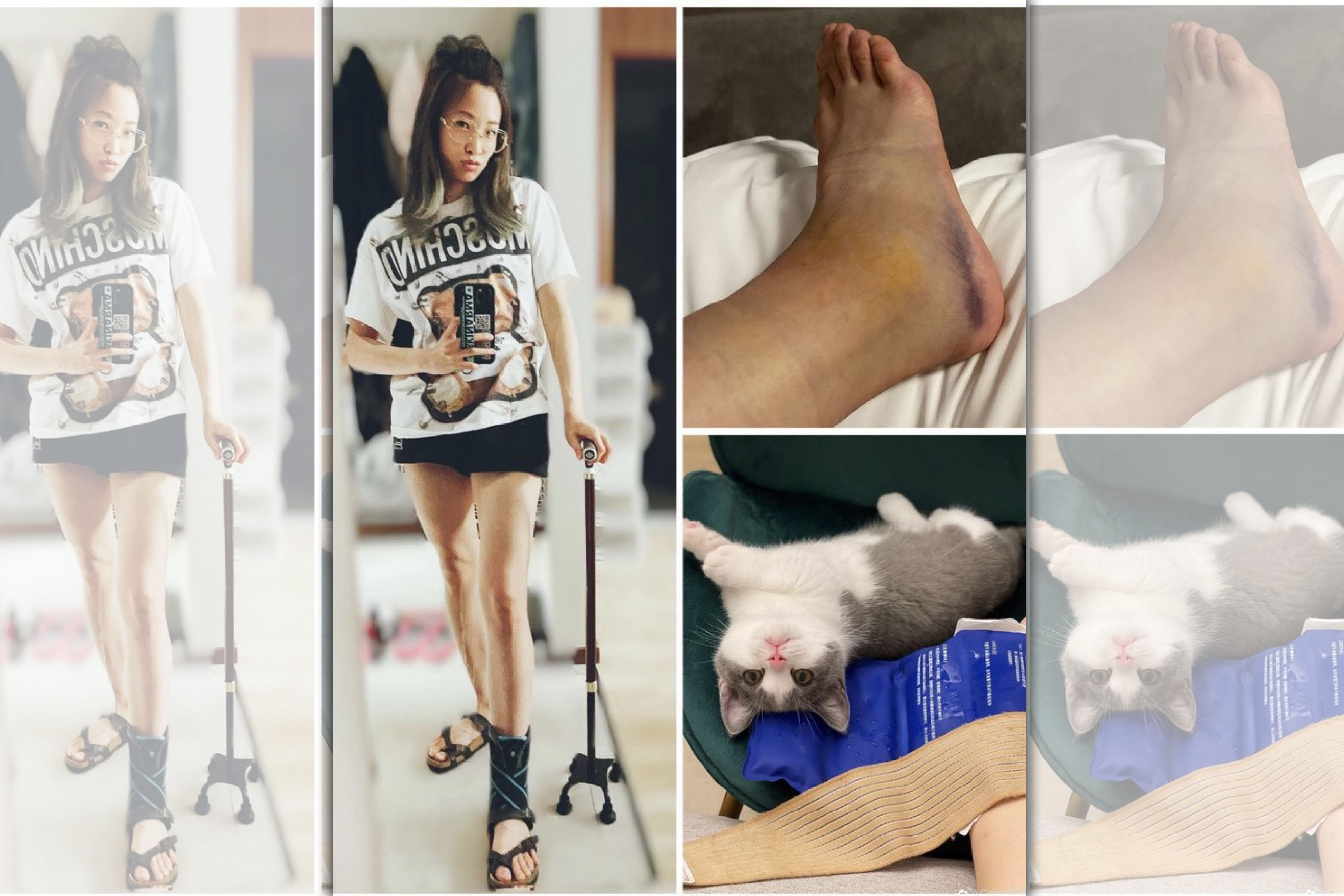 袁詠琳腳踝受傷後馬上掛急診,當時以為只是扭傷,沒想到3週後,依然還是瘀血、腫脹。(翻攝自IG)