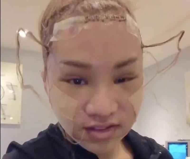 小A辣動完刀臉腫成豬頭。（翻攝自小A辣IG）