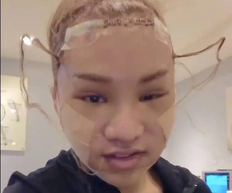 小A辣動完刀臉腫成豬頭。（翻攝自小A辣IG）