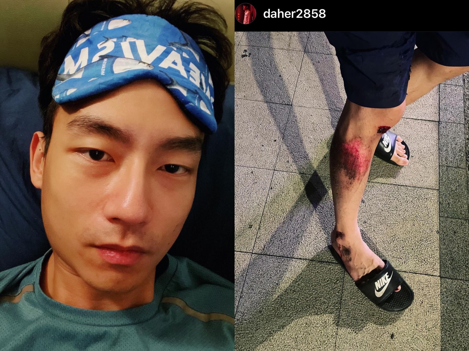 大鶴騎車載妹妹下班自摔，兄妹倆右小腿大面積擦傷。（翻攝自大鶴IG）