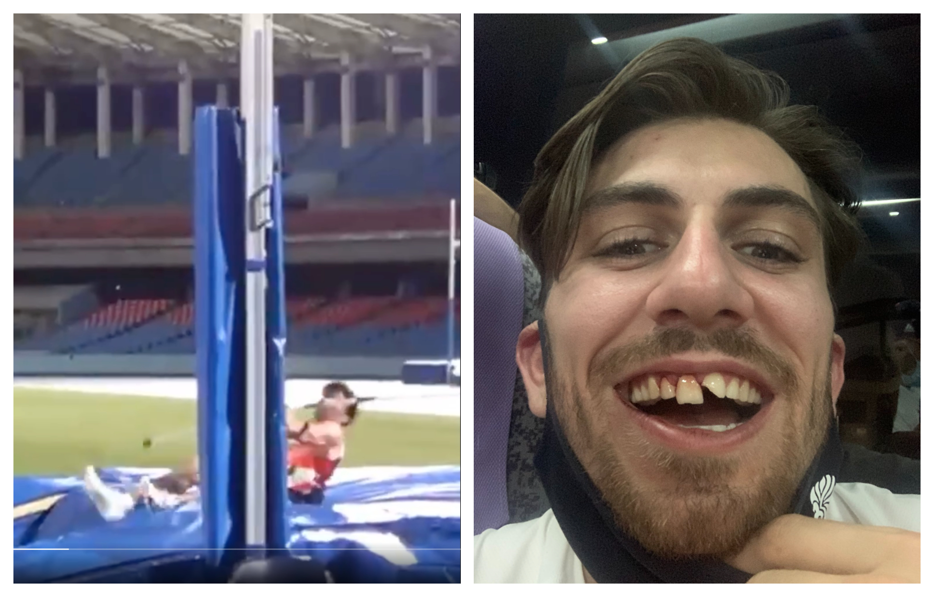 英國撐竿跳選手柯佩爾日前在練習時被橫桿砸中嘴巴，導致門牙被撞斷。（翻攝Harry Coppell IG）