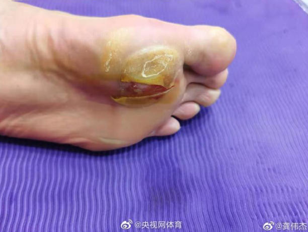 諶龍腳底起了個大水泡，傷口還破掉見肉了。（翻攝微博）