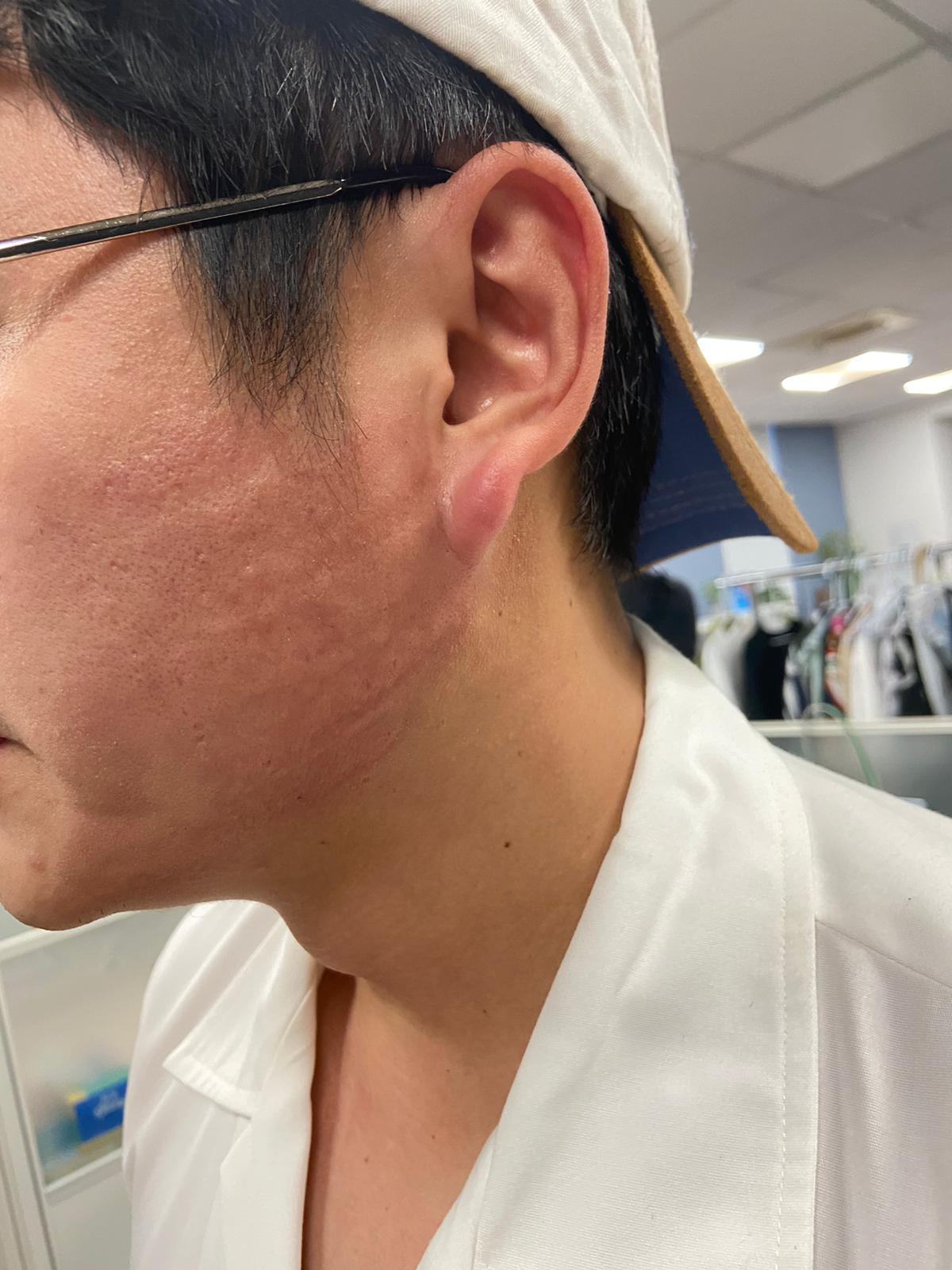 黃靖倫遭葛蕾甩巴掌後留下紅印痕。（TVBS提供）