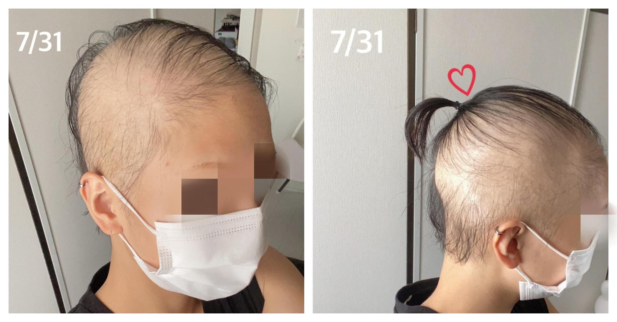 一名日本女子打完莫德納疫苗後出現大量掉髮症狀。(翻攝ameblo.jp網站)