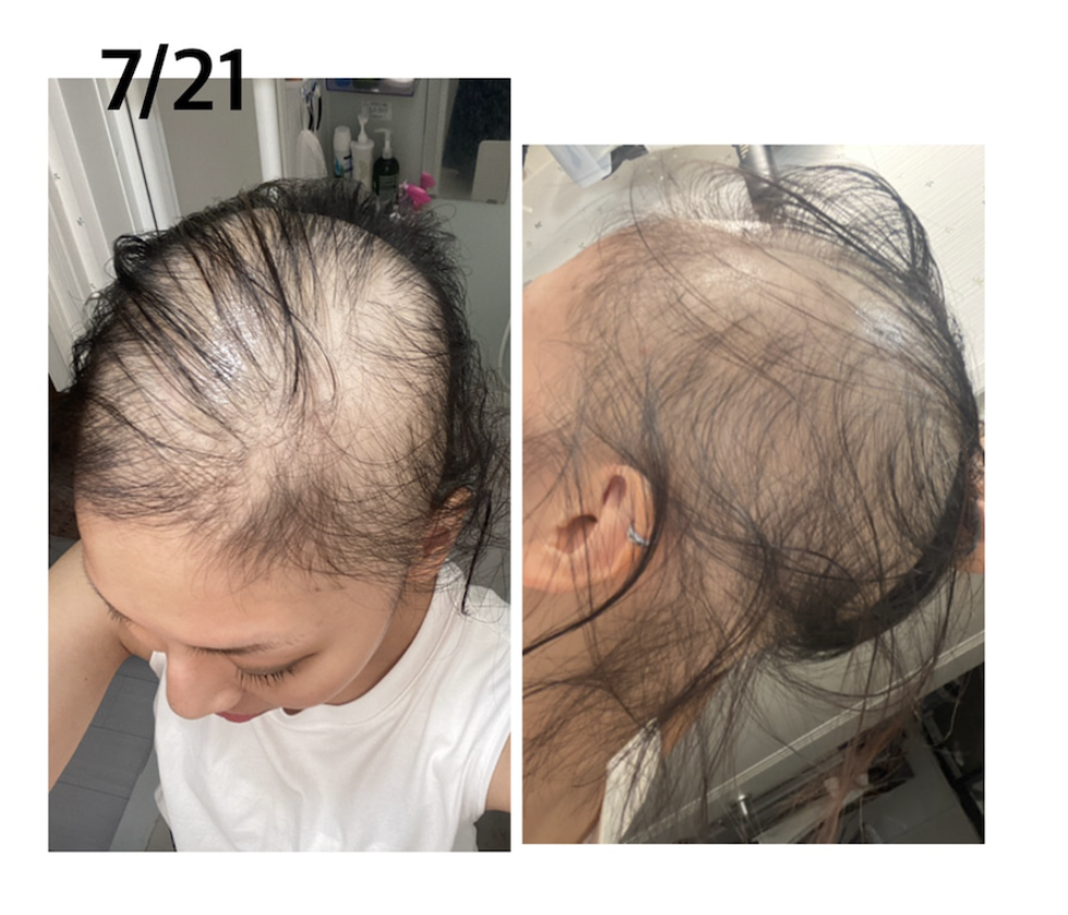 7月21日，頭上頭皮已經處可見。（翻攝ameblo.jp網站）