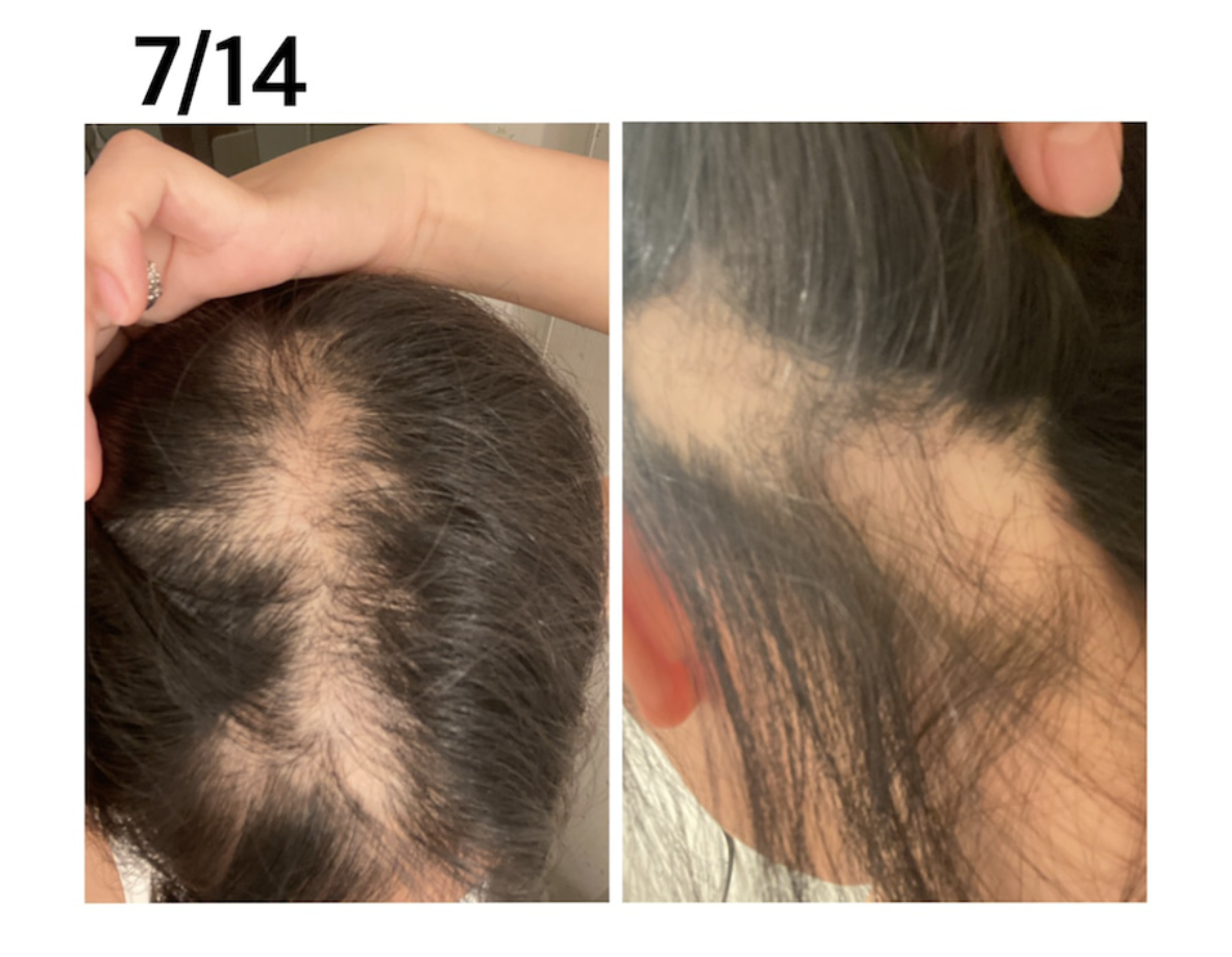 7月14日,頭頂已變得非常稀疏。(翻攝ameblo.jp網站)