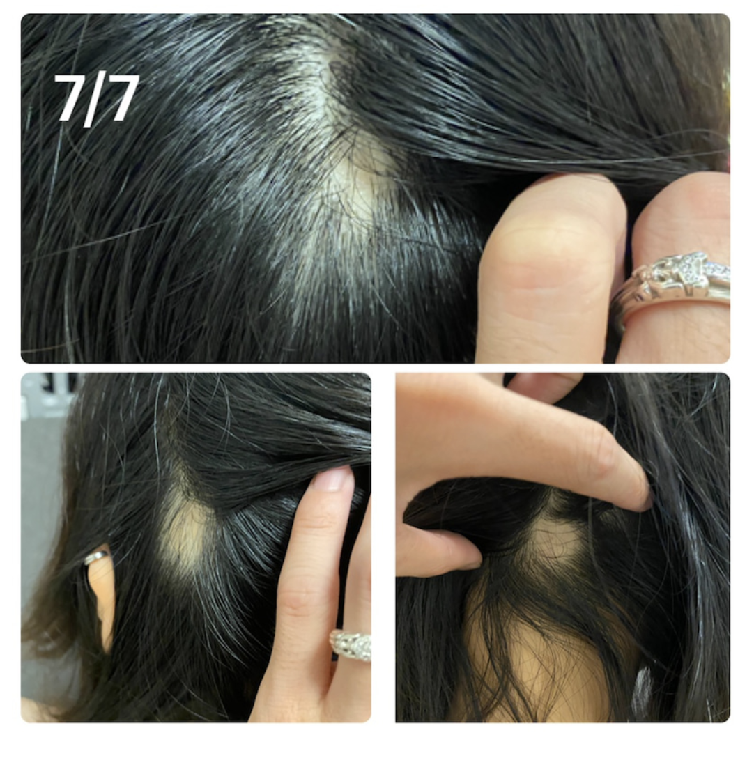 7月7號頭上出現3個圓形禿。(翻攝ameblo.jp網站)