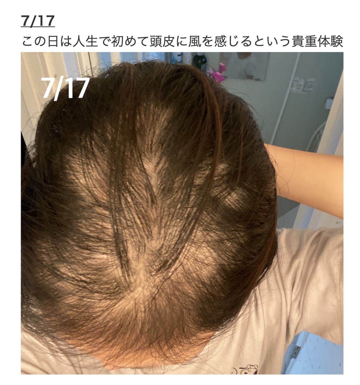 7月17日,頭髮已掉了一大半。(翻攝ameblo.jp網站)