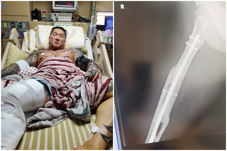 館長陳之漢去年8月遭槍擊，造成他右手臂、右大腿、右小腿中槍，1年後他PO出回診X光照，證明復原良好。（翻攝自飆捍臉書）