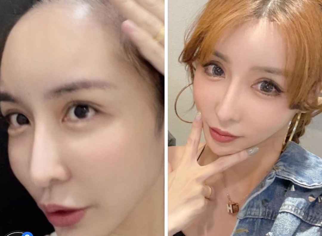 雪碧公開最新整形照，縮短額頭、假體換3D骨水泥、提眉，花了一個月休養。（翻攝自雪碧IG）