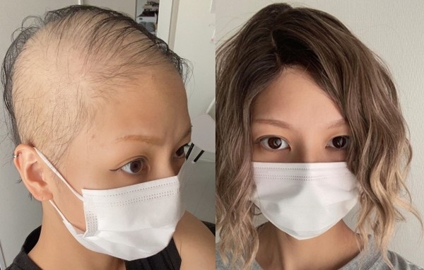 28歲的正妹6月底接種莫德納疫苗2天後開始脫髮，但醫師表示目前無法證實相關性，於是她勇敢地接種第2劑。（翻攝自ameblo IG）