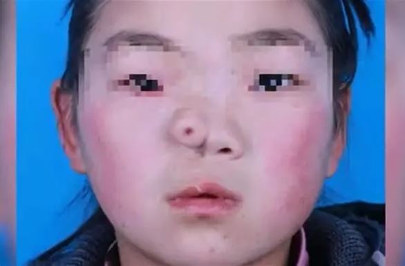 一位女孩因為天生臉部缺陷，出生時就被拋棄，被收養後如今考上醫學院。（翻攝自微博）