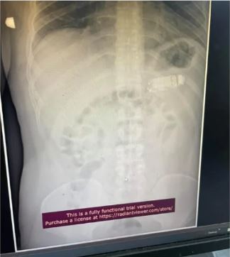 醫師透過X光照片，發現手機橫向卡在男子胃裡。（翻攝Skender Telaku臉書）