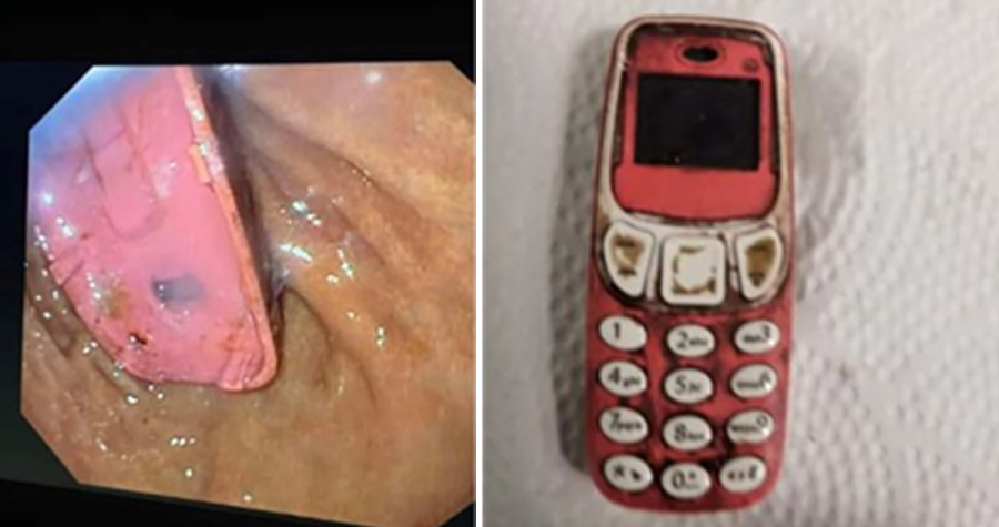 男子的胃裡有一隻停產多年的諾基亞，醫生花了近2個小時才透過內視鏡手術取出手機。（翻攝Skender Telaku臉書）