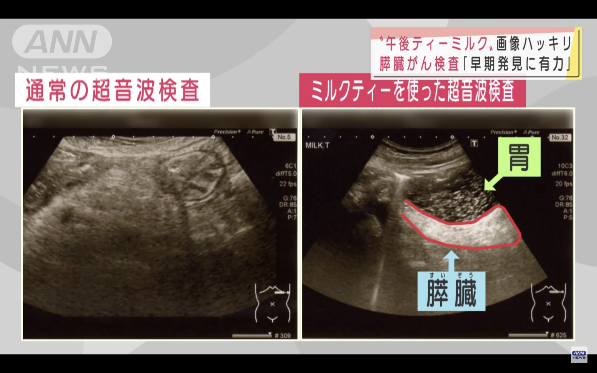 喝下奶茶後再照超音波,可以讓胰臟顯示更完整。(翻攝自ANNnewsCH YouTube)