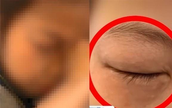 中國浙江省寧波市一名9歲女童只要開始寫數學作業,眼睛周圍就會開始紅腫,出現過敏反應。(翻攝自網易新聞)