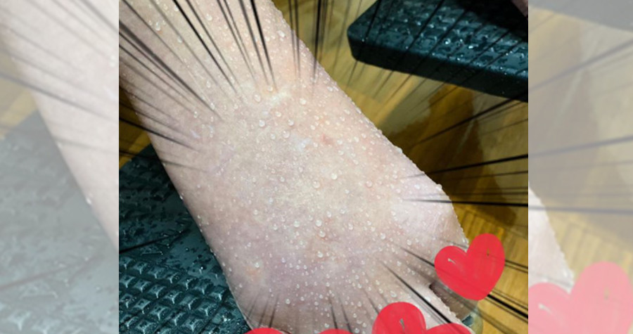 有一位阿嬤因水腫來看門診,沒想到往雙腿一看,不僅水腫的非常嚴重,竟然還滲出大量分泌物,讓美女醫師吳欣岱嚇壞了。(翻攝吳欣岱臉書)