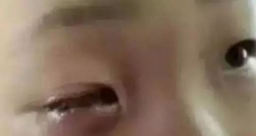男童的右眼終生失明,連醫生都表示任何醫療方法都回天乏術。(翻攝新浪新聞)