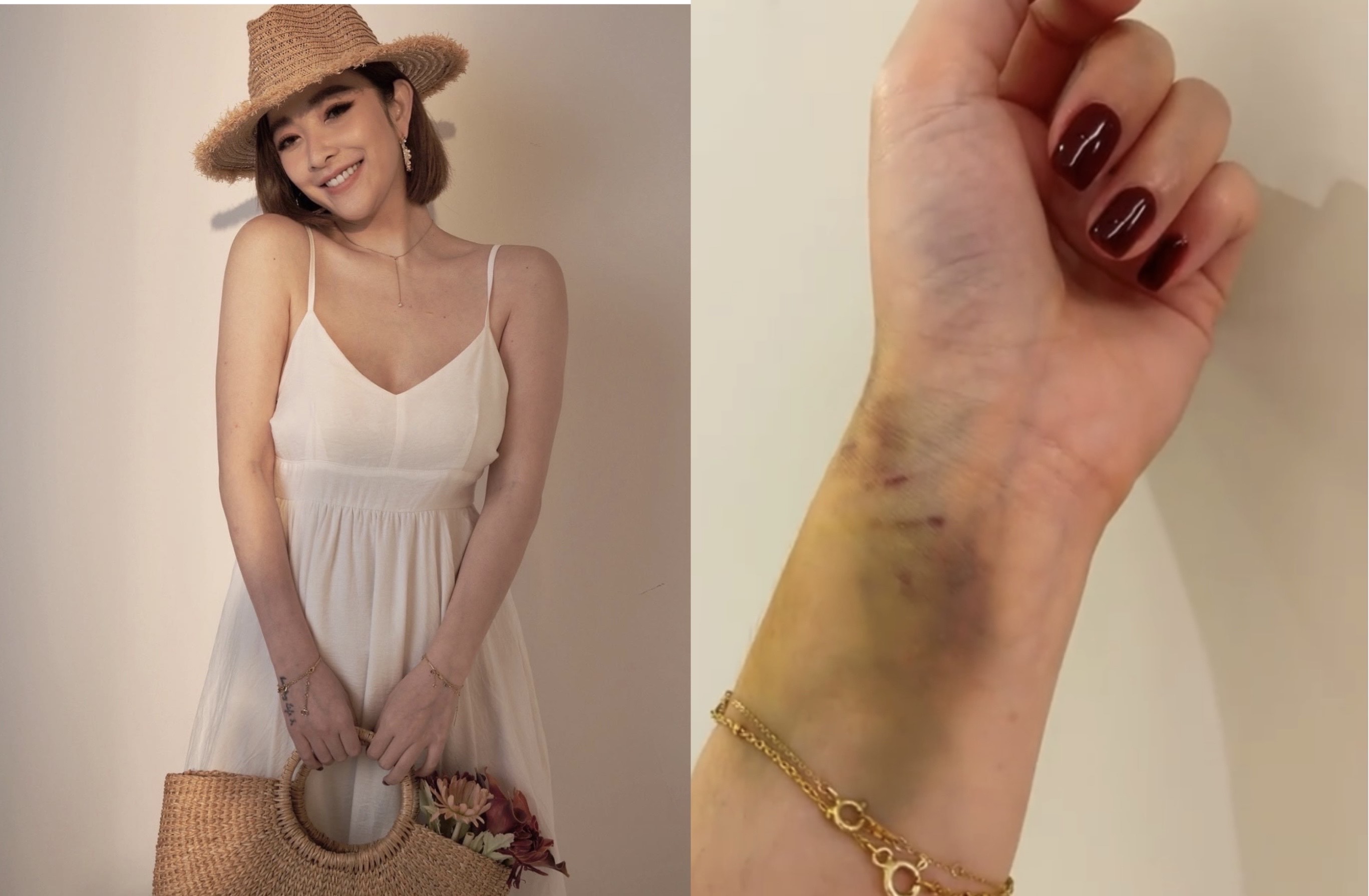 許維恩練重訓練過頭導致手腕受傷。（翻攝自許維恩臉書）