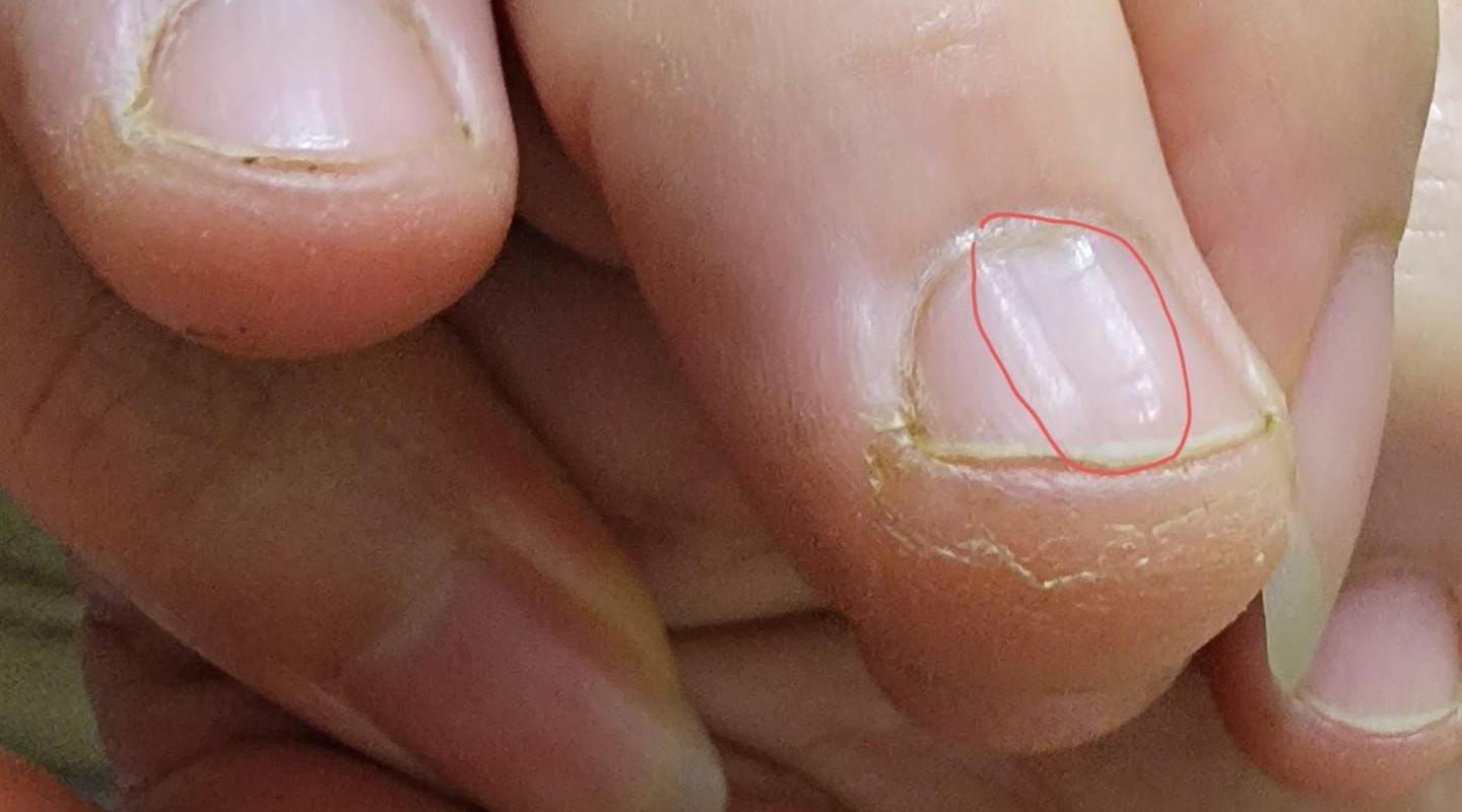 女網友無意間發現自己指甲表面上有「一道凹槽」,讓她擔心是不是身體有狀況。(翻攝爆系知識家)