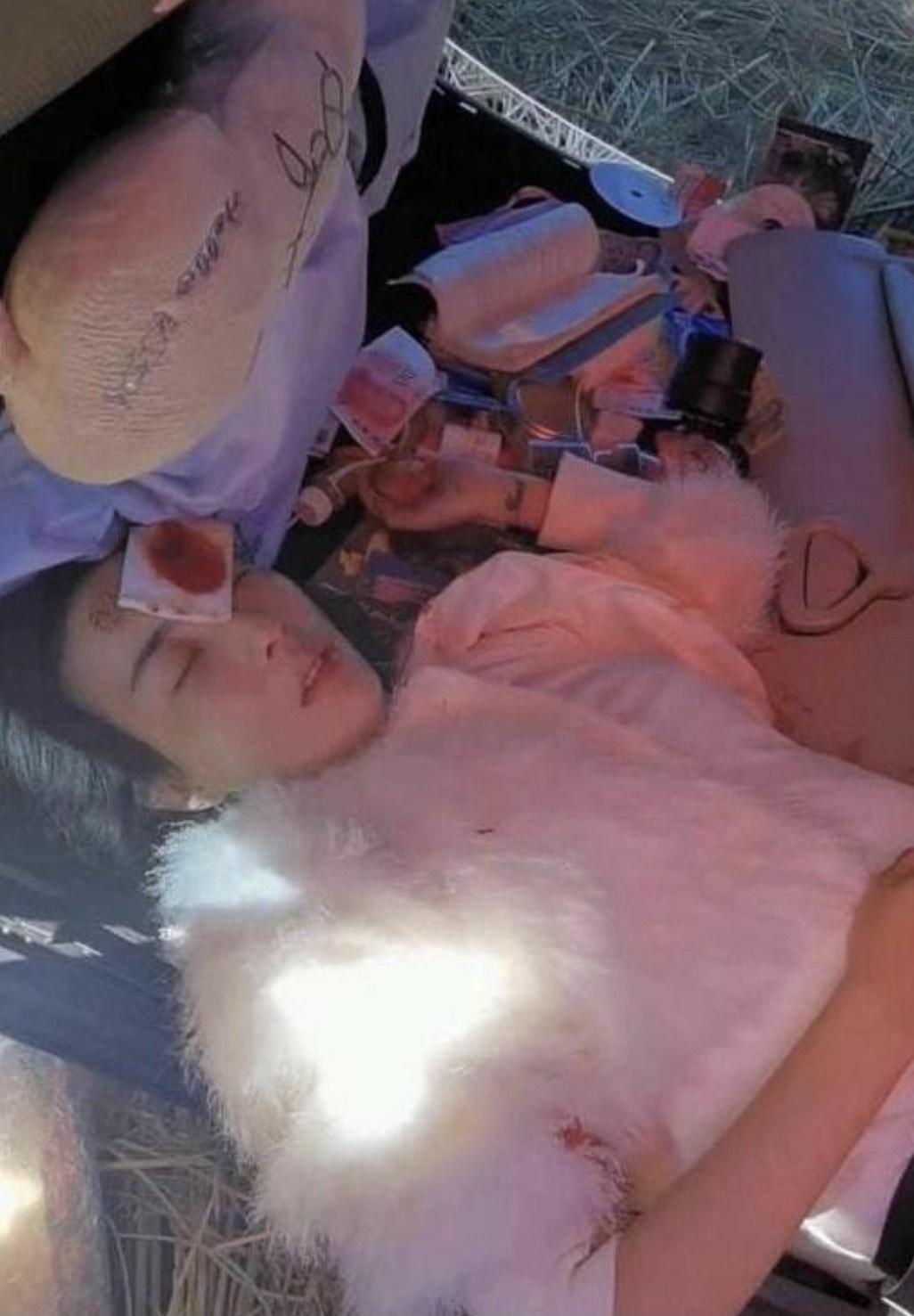 李羲兒左眉弓骨骨折,三層深縫54針。(翻攝自新浪微博)